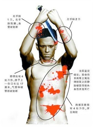Graphic showing the locations of Mr. Xie's stab wounds.
