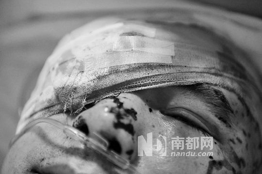 南都网 | 广东半职业举报人遭断指泼硫酸 右眼被砍失明